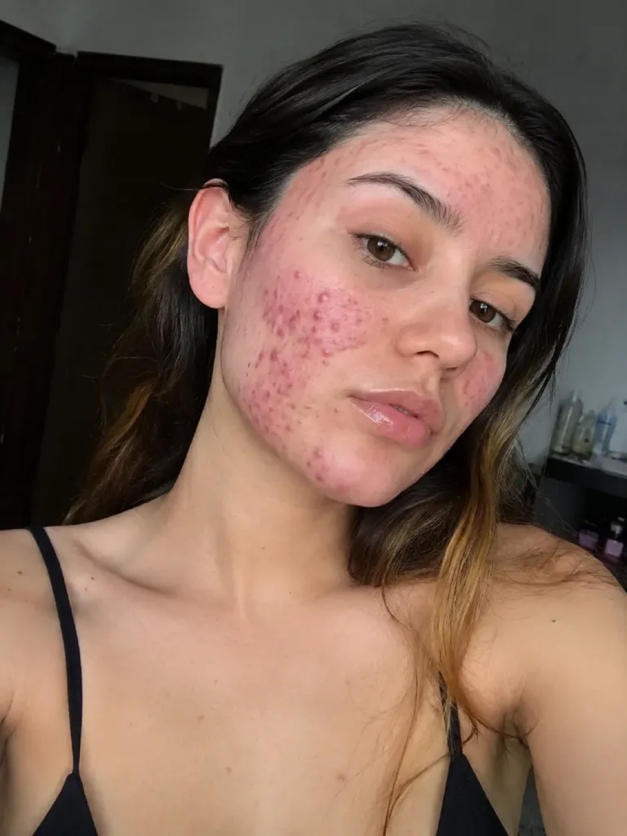 Estado antes del tratamiento facial para acné