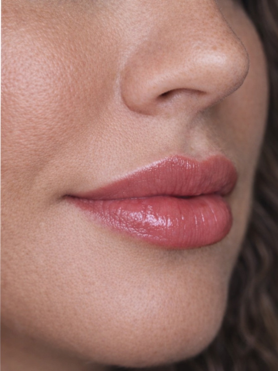 Resultado después del tratamiento de labios