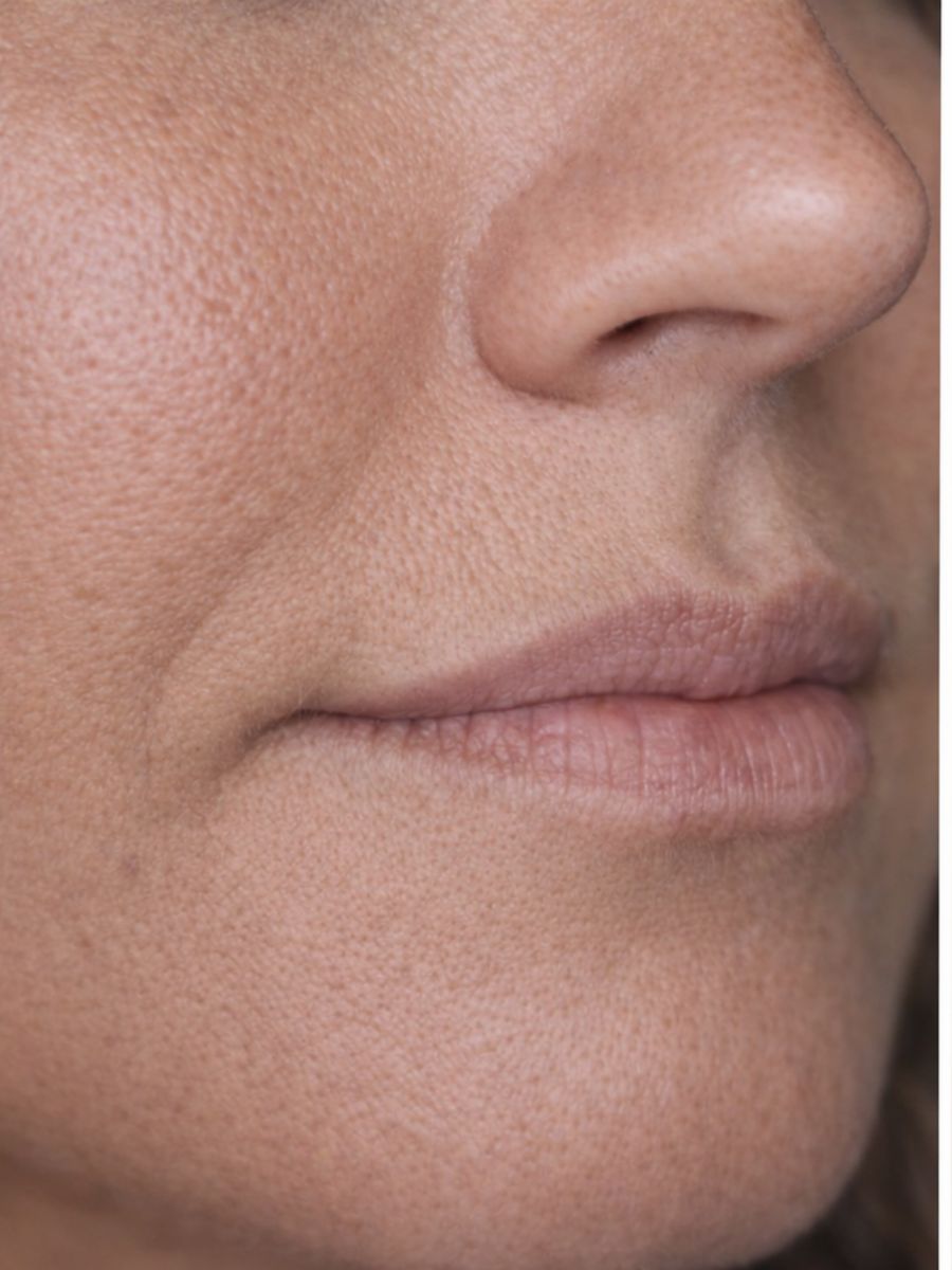 Resultado real Ekobell: Labios y perfil facial