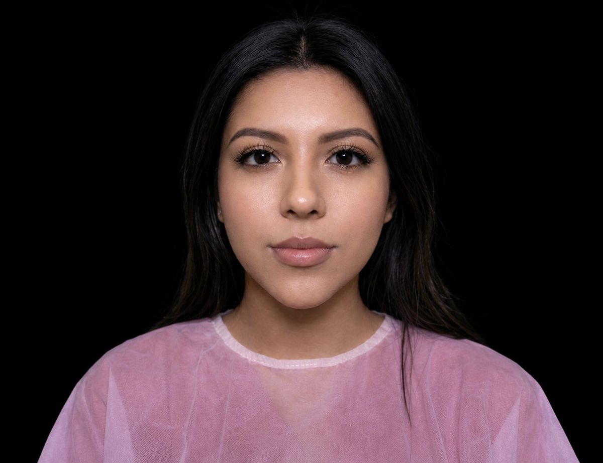Resultado real Ekobell: Rejuvenecimiento facial
