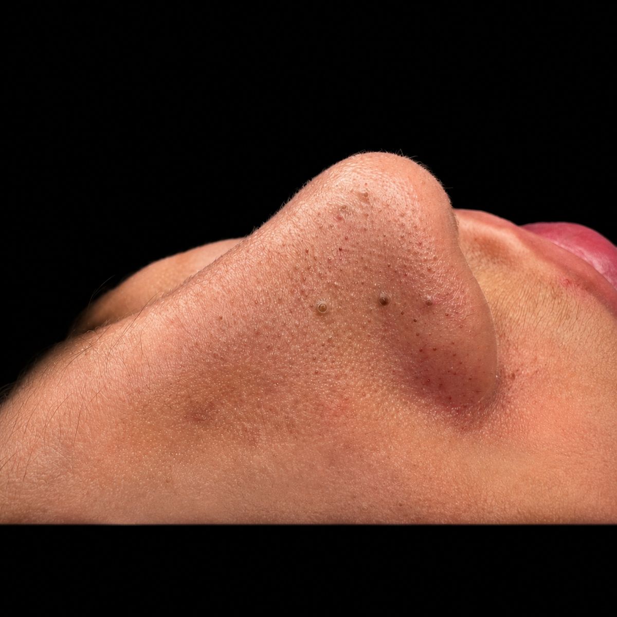 Resultado real Ekobell: Rejuvenecimiento facial