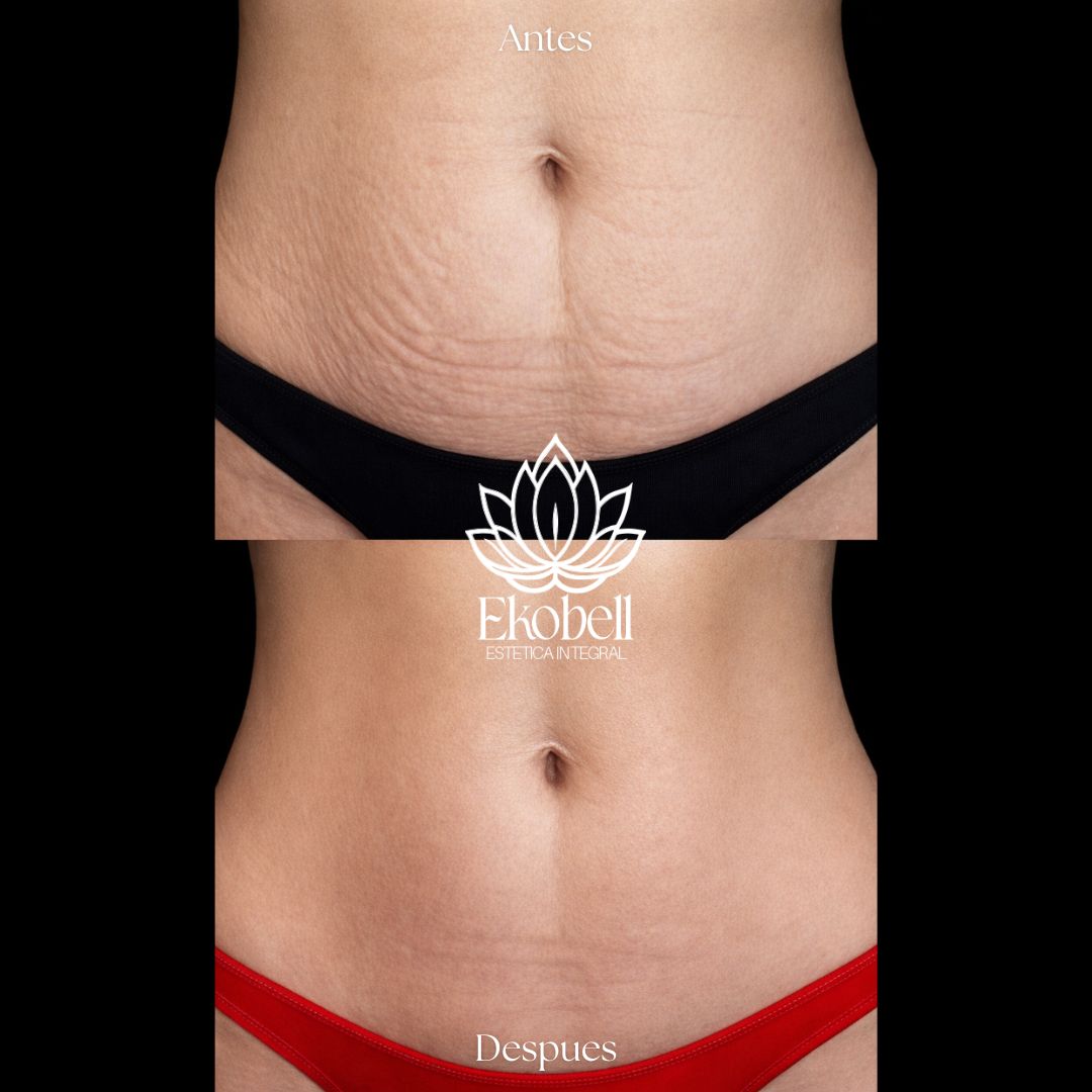 Resultado real Ekobell: Remodelación corporal