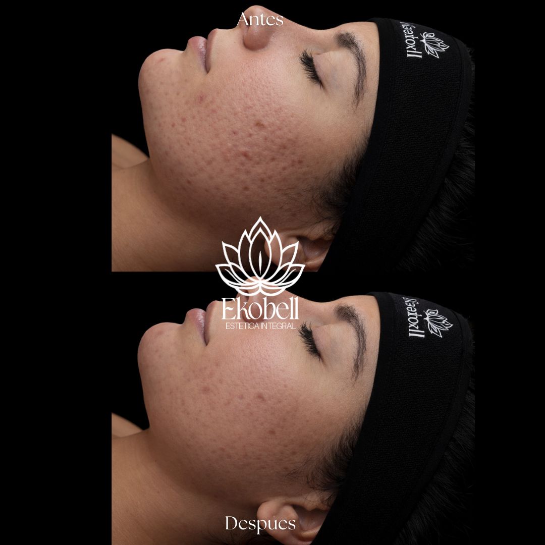 Resultado real Ekobell: Rejuvenecimiento facial