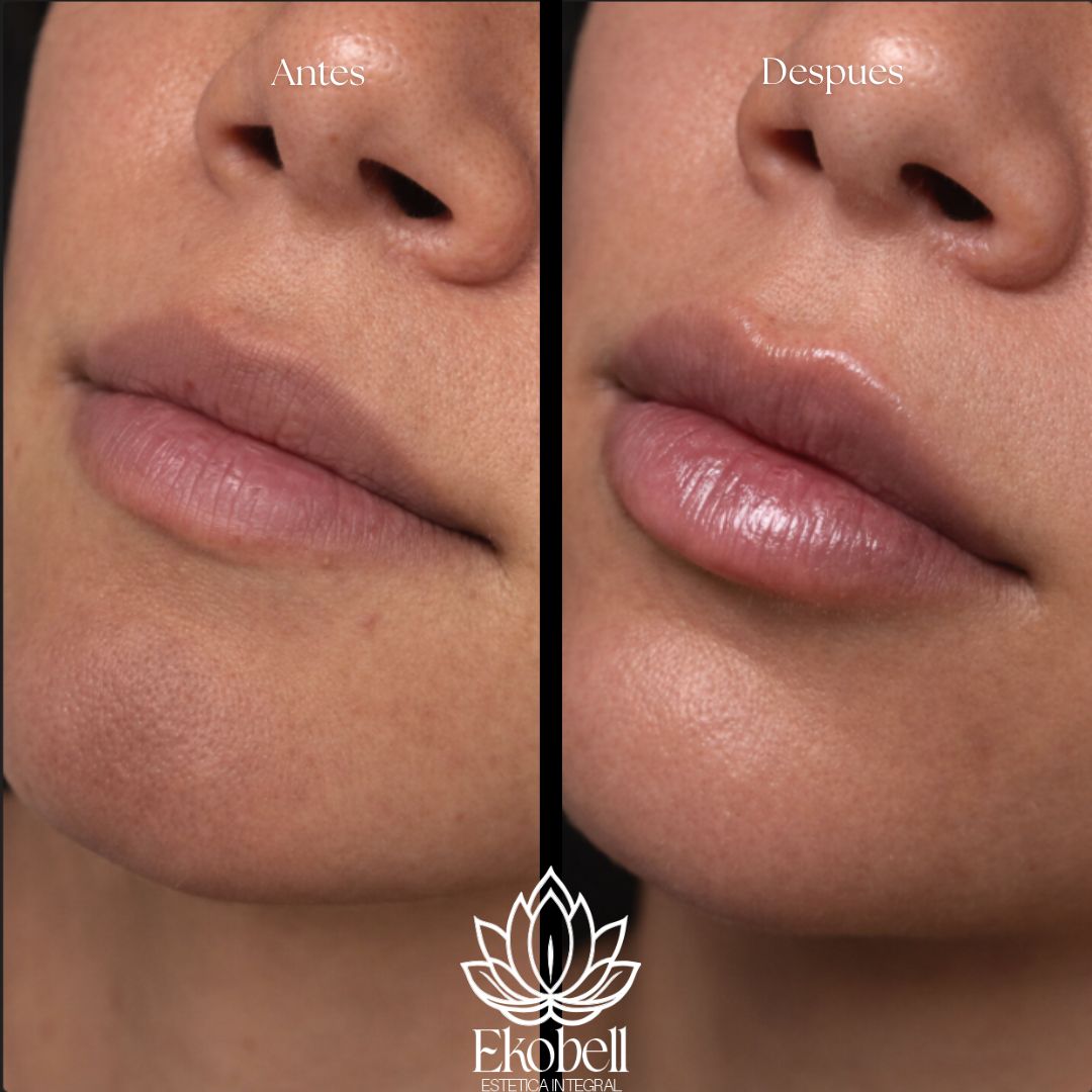 Resultado real Ekobell: Labios y perfil facial