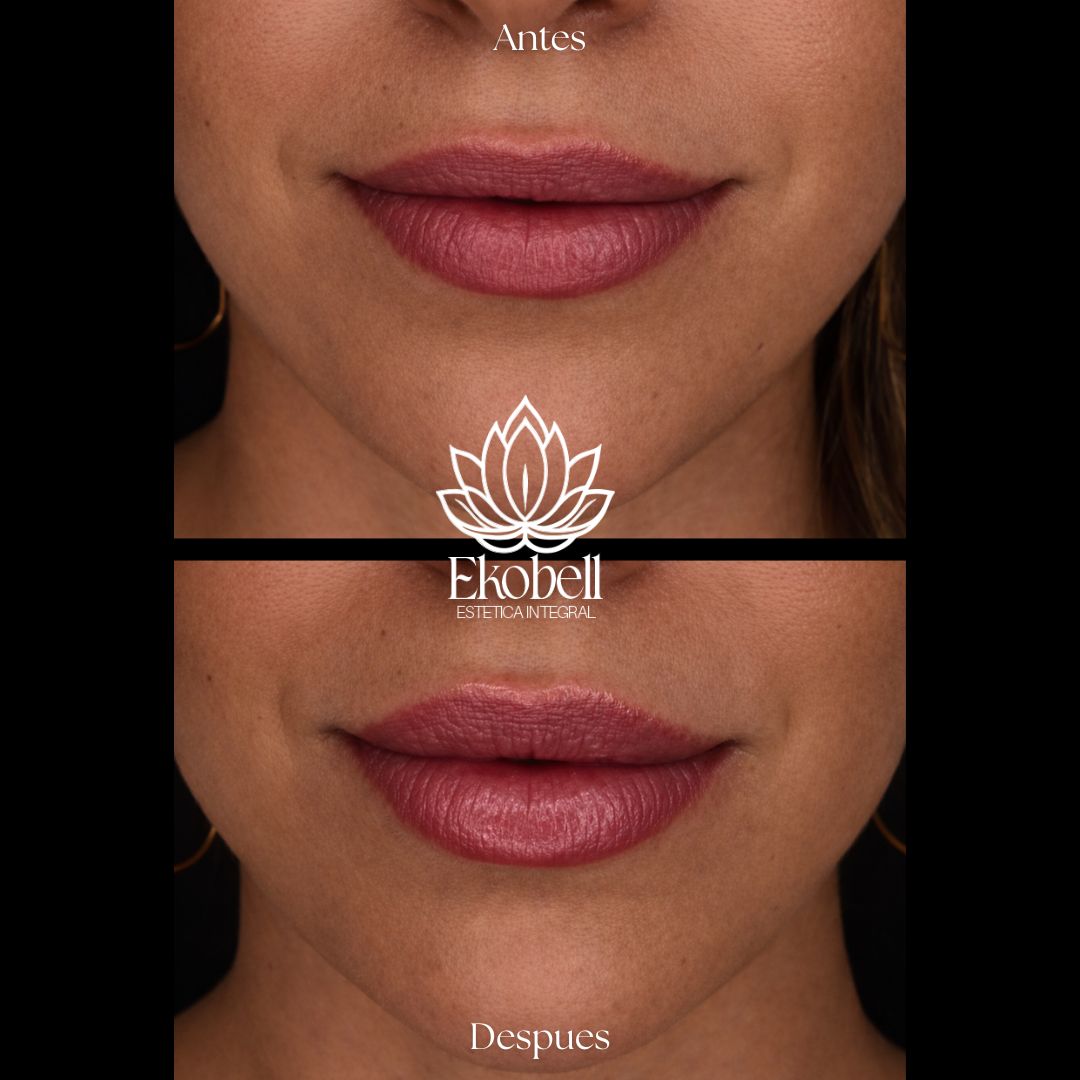Resultado real Ekobell: Labios y perfil facial