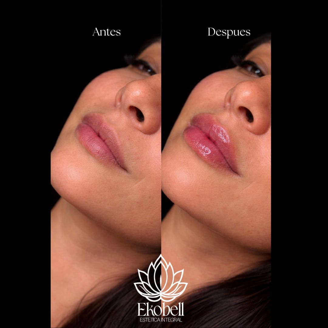 Resultado real Ekobell: Labios y perfil facial