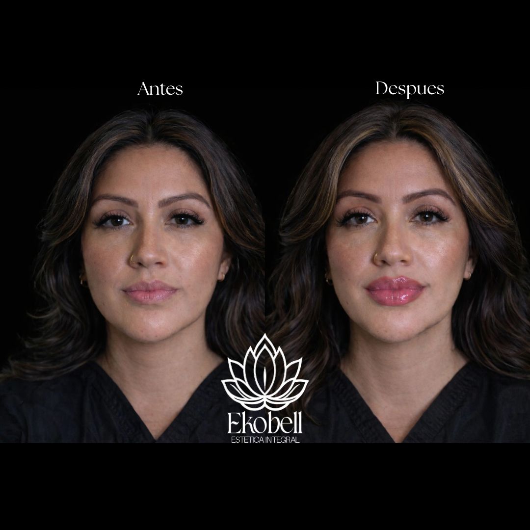 Resultado real Ekobell: Labios y perfil facial