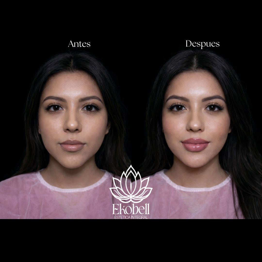 Resultado real Ekobell: Labios y perfil facial