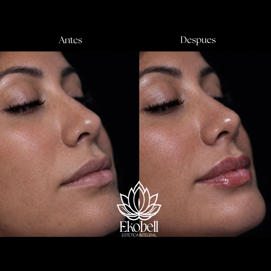 Resultado real Ekobell: Labios y perfil facial