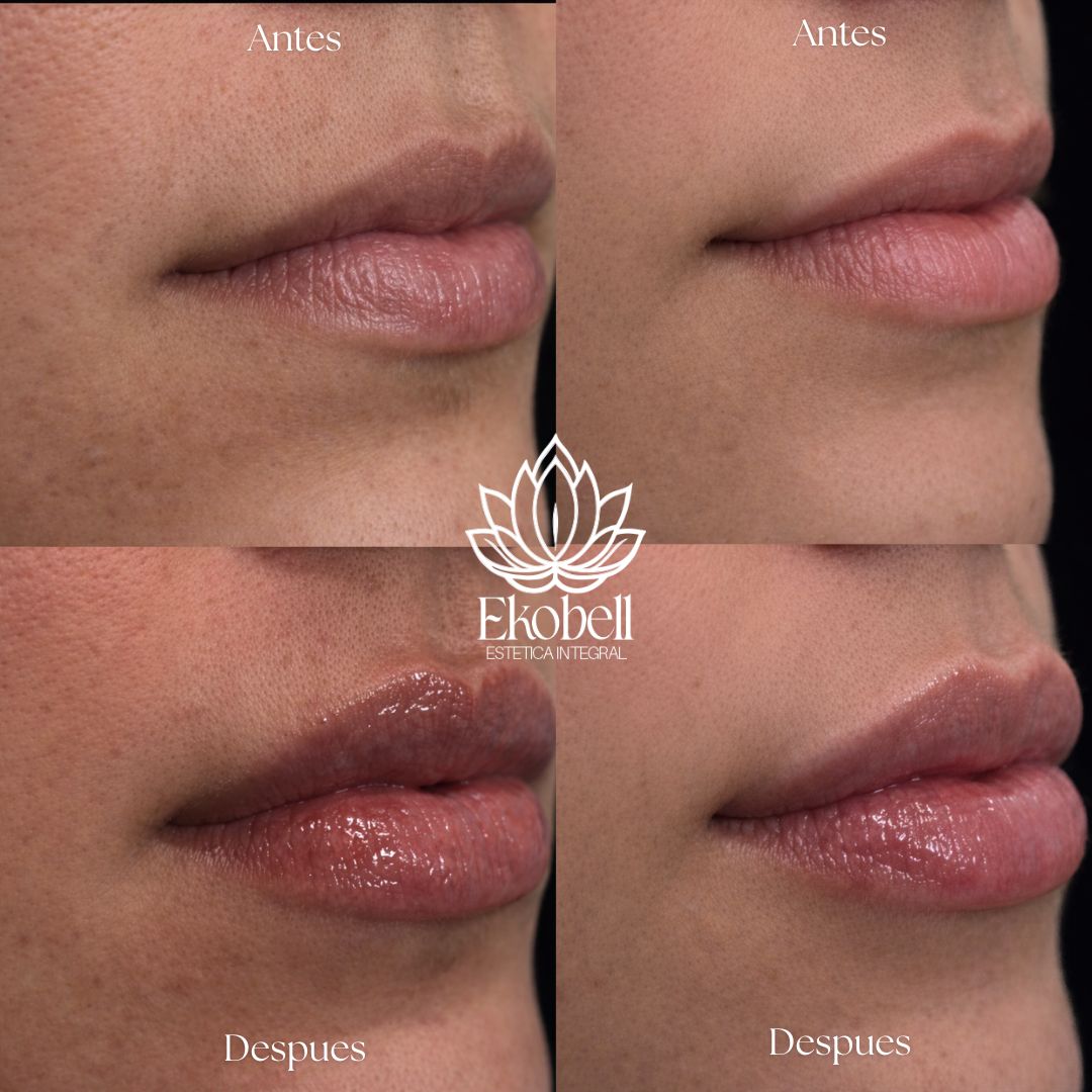 Resultado real Ekobell: Labios y perfil facial
