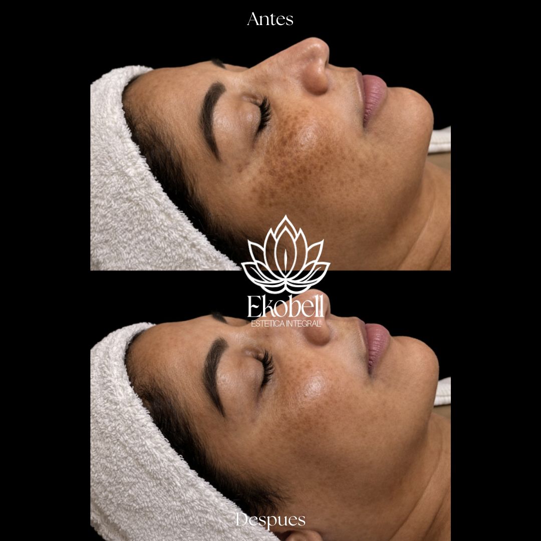 Resultado real Ekobell: Rejuvenecimiento facial