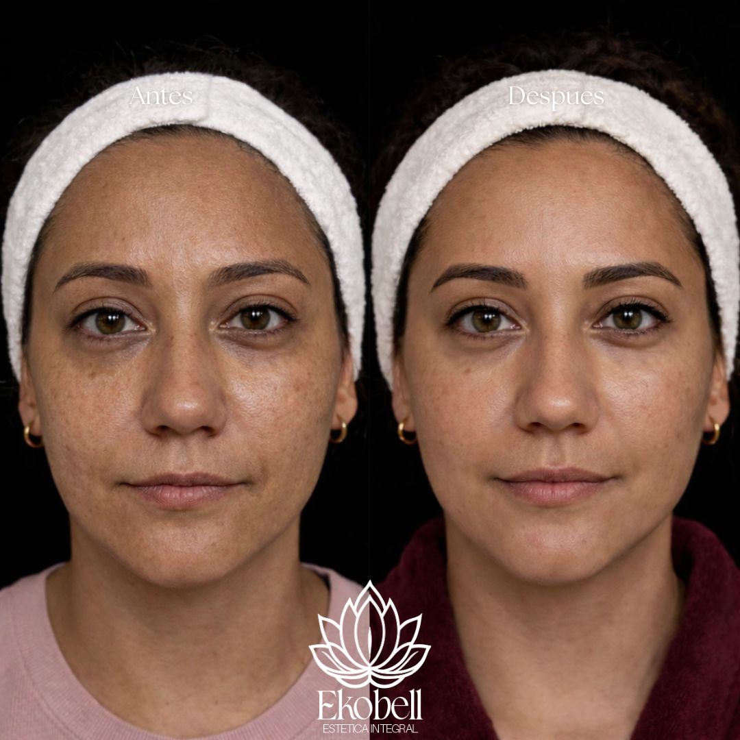 Resultado real Ekobell: Rejuvenecimiento facial