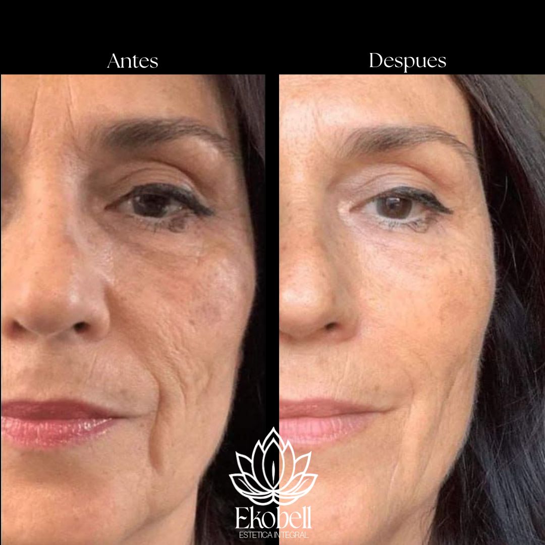 Resultado real Ekobell: Rejuvenecimiento facial