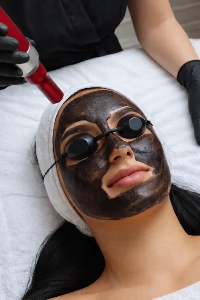 Hollywood Carbon Laser Peel (2 Unidades)